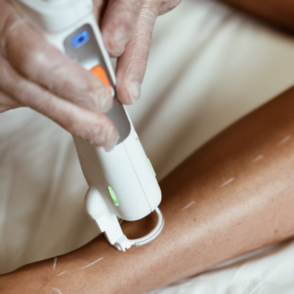 Epilation laser définitive en cours à Caen