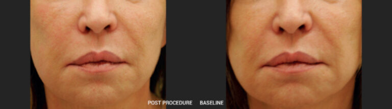 HIFU - Lifting sans chirurgie - Avant/Apres