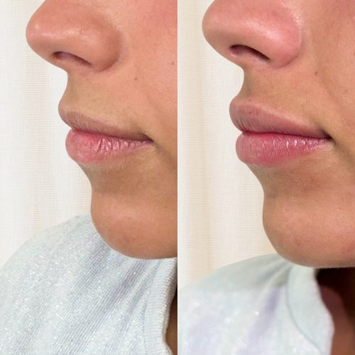 Injection des lèvres avant/après